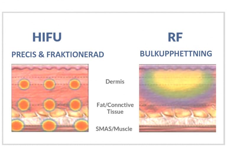 HIFU-RF