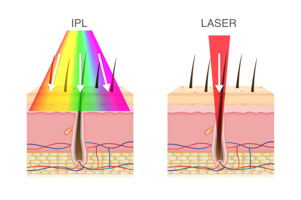 What is the difference between IPL and laser?